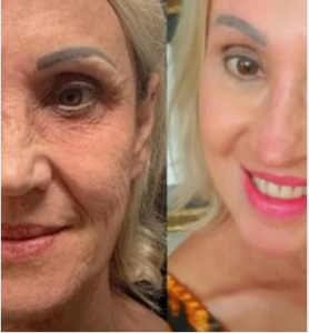 fotos_peeling_de_fenol_-_Pesquisa_Google_-_2024-05-03_10.32.52